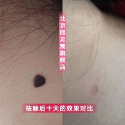 -美人痣全国连锁