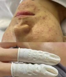 -瑶芳清颜草本祛痘