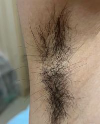 -薇兰专业脱毛连锁机构