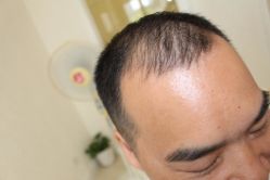 -大麦微针植发丨全国连锁