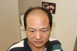 点击看大图 -大麦微针植发丨全国连锁