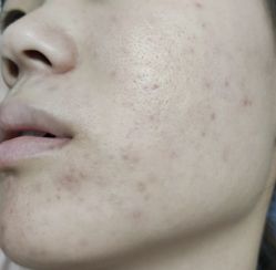 -苗方清颜痘肌研究所