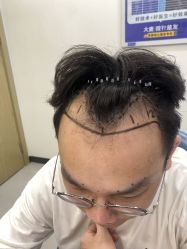 -大麦微针植发全国连锁