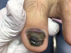 -Andrew指甲专科灰指甲·甲沟炎矫正·3D步态矫形鞋垫定制(浦三路店)