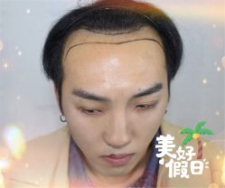 -大麦微针植发全国连锁
