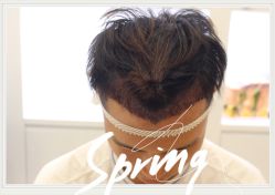 点击看大图 -大麦微针植发全国连锁