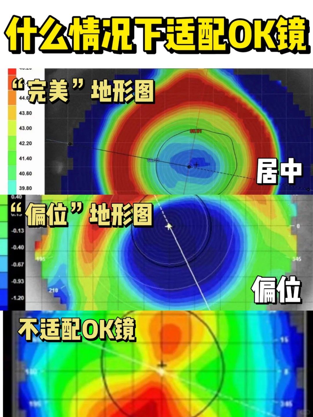 怎么看角膜地形图呢?