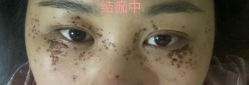 -爱莎扁平疣·汗管瘤·斑痣中心