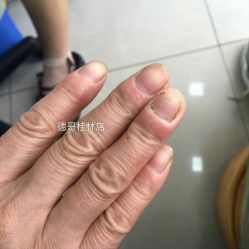 -德哥灰指甲脚气甲沟炎跖疣护理