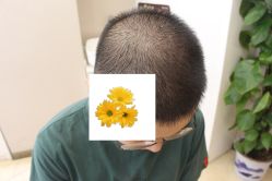 -大麦微针植发丨全国连锁