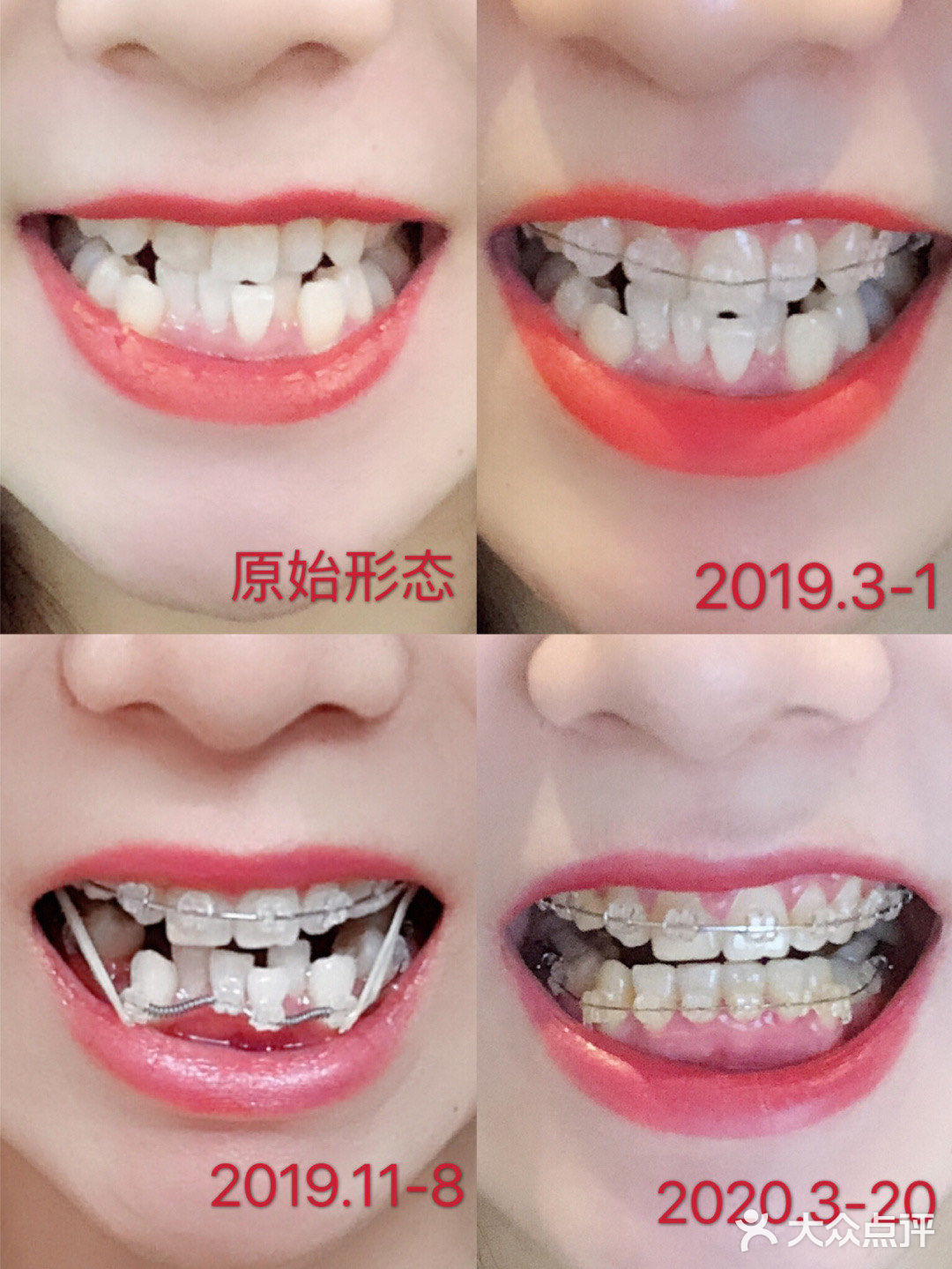 今天很高兴收到了顾客的矫正反馈图