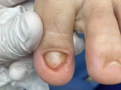 -Andrew指甲专科灰指甲·甲沟炎矫正·3D步态矫形鞋垫定制(上海法华镇路旗舰店)