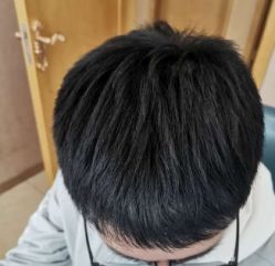 -大麦微针植发丨全国连锁