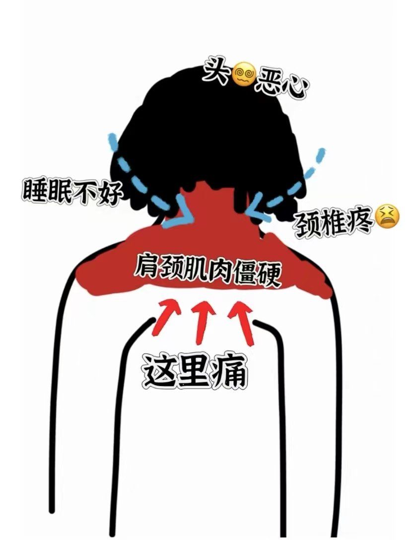 颈椎酸痛,僵硬松解修复受损筋膜看这里