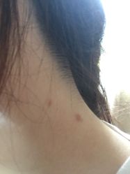 -爱莎扁平疣·汗管瘤·斑痣中心