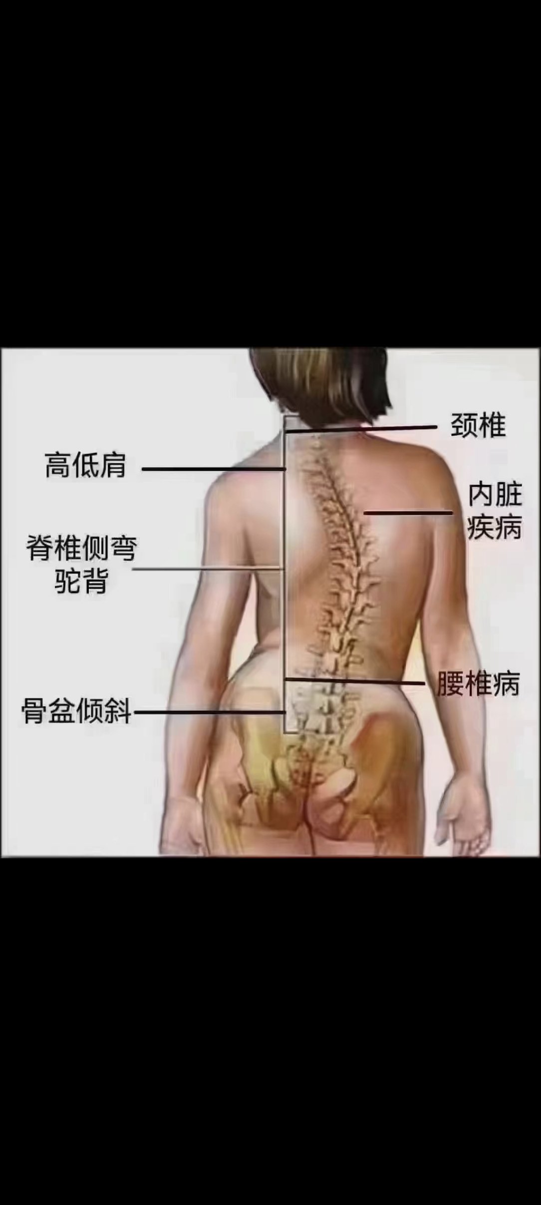 五脏六腑都挂在脊柱上 \\n外在变形