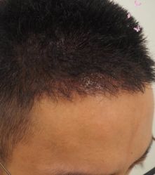 -大麦微针植发丨全国连锁