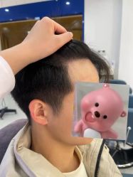 体验后-大麦微针植发全国连锁