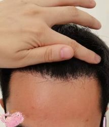 -大麦微针植发丨全国连锁