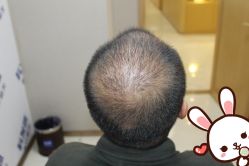 -大麦微针植发丨全国连锁