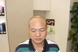 点击看大图 -大麦微针植发丨全国连锁