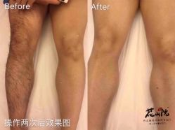 -觅屿日式脱毛美肤