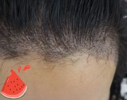 -大麦微针植发丨全国连锁