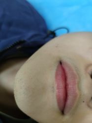 体验前-成都西区医院整形美容