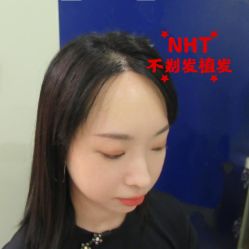 -碧莲盛·不剃发植发