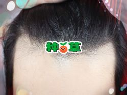 -大麦微针植发全国连锁