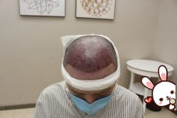 -大麦微针植发丨全国连锁