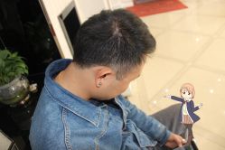 -大麦微针植发丨全国连锁