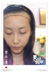 -大麦微针植发全国连锁