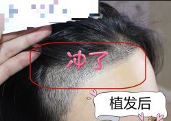 -大麦微针植发全国连锁