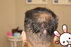 -大麦微针植发丨全国连锁