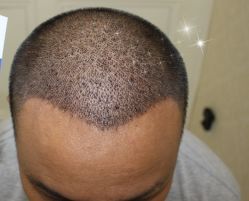 -大麦微针植发丨全国连锁