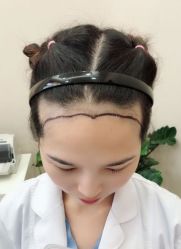 -大麦微针植发全国连锁