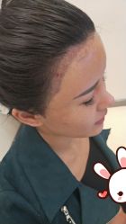 点击看大图 -大麦微针植发丨全国连锁