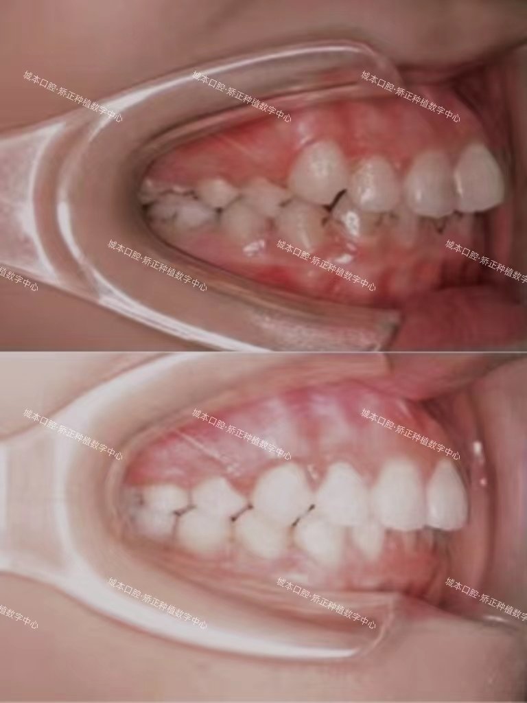 牙突拔牙矫正案例分享