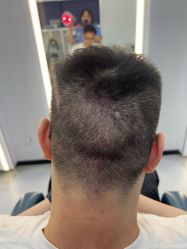 -大麦微针植发全国连锁