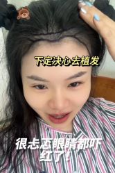 -碧莲盛·不剃发植发