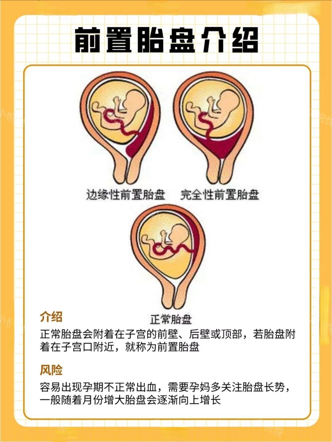 一次搞清楚胎盘前壁/后壁/上怀/下怀区别