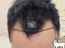 -大麦微针植发全国连锁