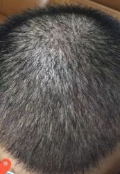 -大麦微针植发丨全国连锁