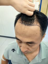 点击看大图 -大麦微针植发全国连锁