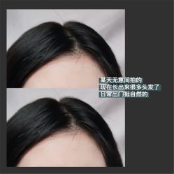 -碧莲盛·不剃发植发