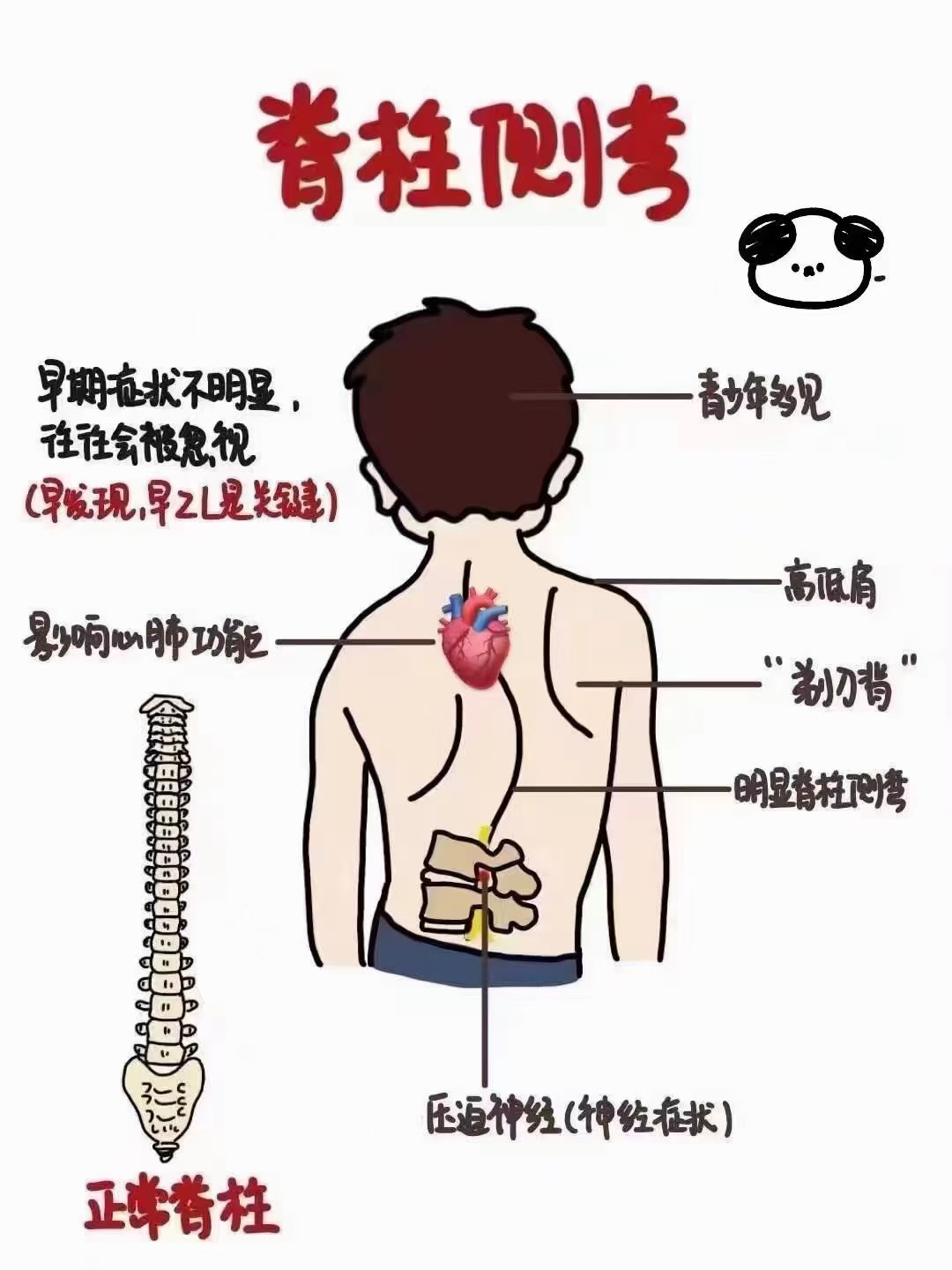 脊柱弯曲的危害图片