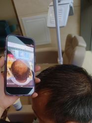 -碧莲盛·不剃发植发