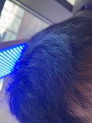 -碧莲盛·不剃发植发