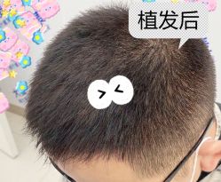 -大麦微针植发全国连锁